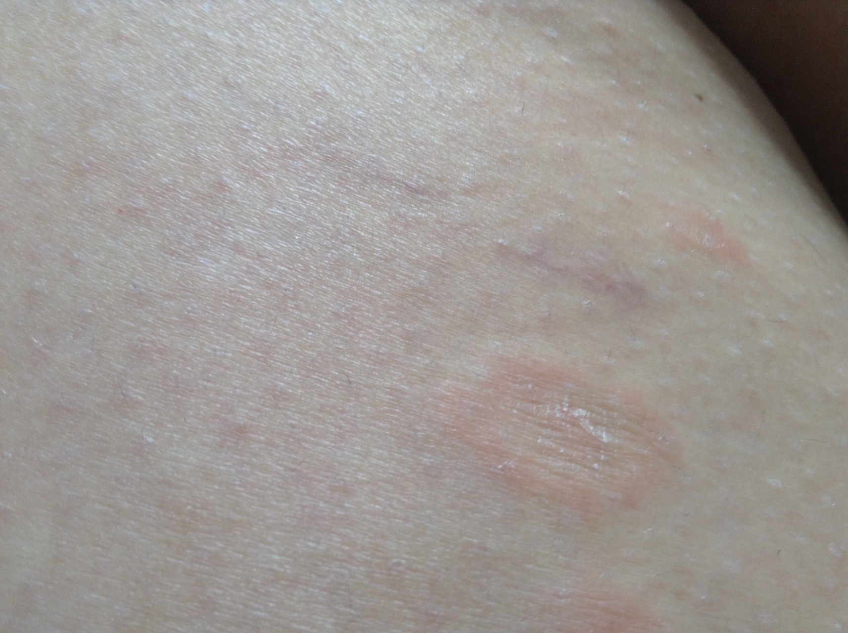 Аллергическая сыпь на коже у ребёнка: как выглядят высыпания при аллергии и чем их лечить + фото и видео
