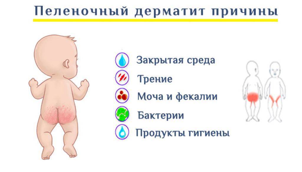 Пеленочный дерматит | уроки для мам