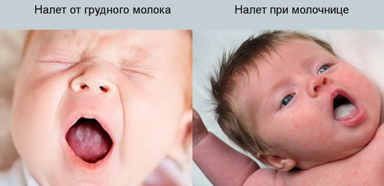 Белый налет на языке у ребенка: 3 основных причины и 3 способа очистить язых грудничку