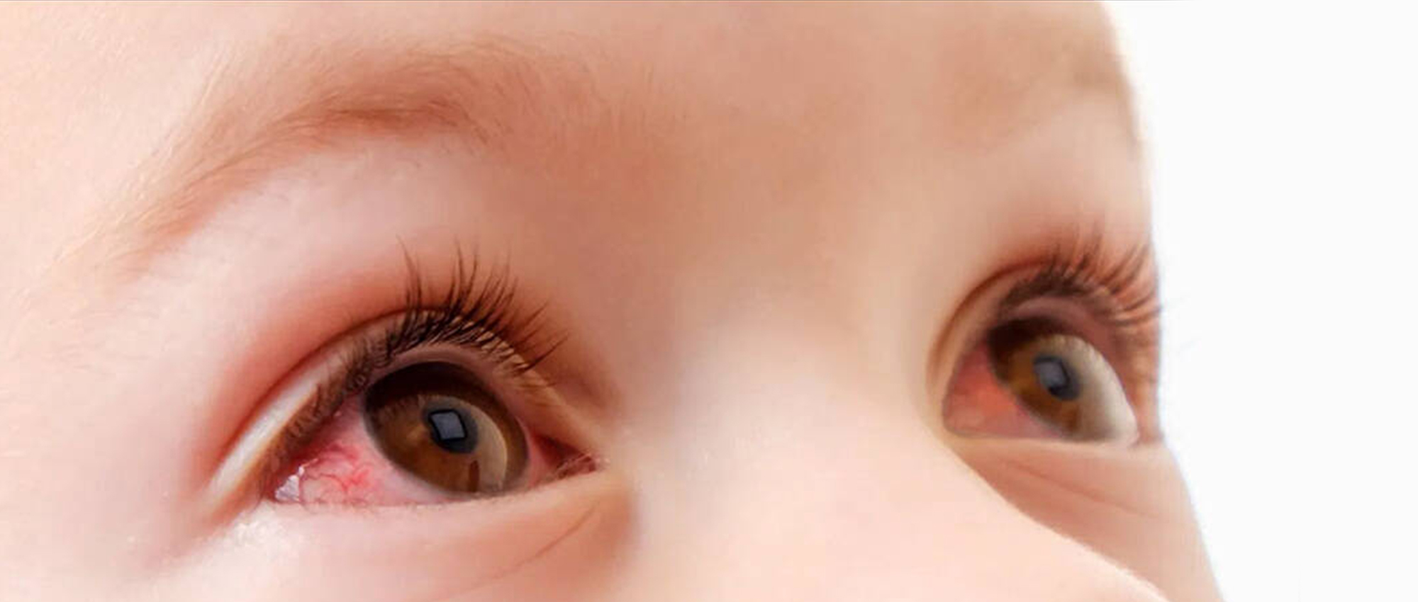 Почему младенцы красные. Детские глаза. Красные глазаму ребенка.