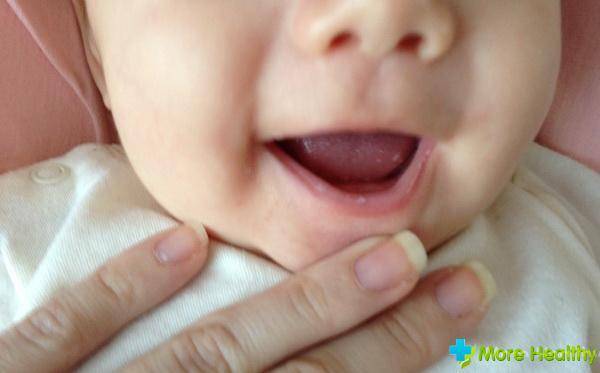 Мозоль на верхней губе у новорожденного: причины, лечение у грудничков и младенцев