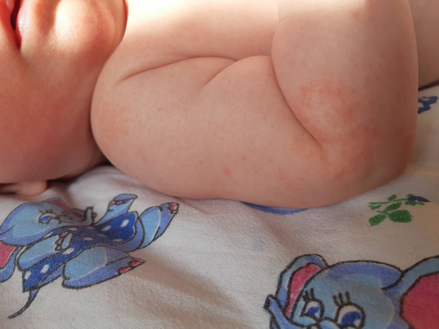 Аллергия у грудничка (новорожденного): как выглядит и чем лечить (+фото)