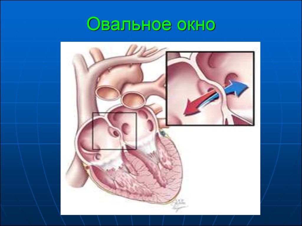 Если у новорождённого открытое овальное окно в сердце — разъясняет детский кардиолог