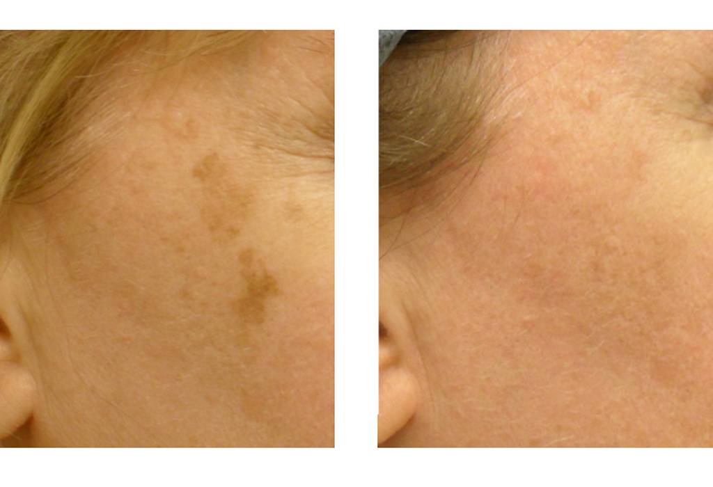 Пигментация кожи: основные причины и способы лечения - клиника "отражение"