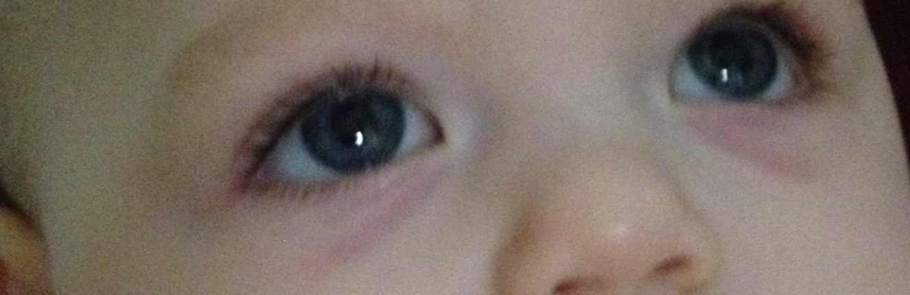 Глазки в 3 месяца. Кровоподтеки под глазами у ребенка. Синякитподтшлазами у ребенка. Синяки под глазами у грудничка.