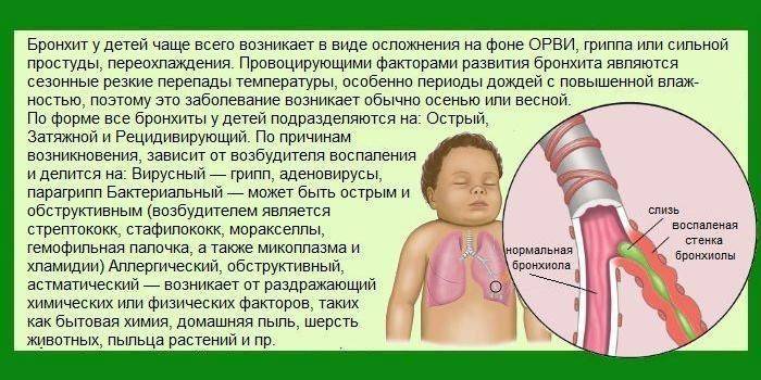 Трахеит у детей: причины, симптомы, как лечить | омнитус®