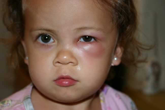 Отеки под глазами у ребенка: причины припухлости нижнего века у грудничка до года и после, лечение, профилактика