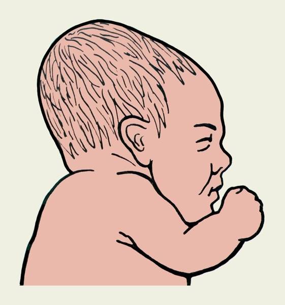 Плагиоцефалия у ребенка – неправильная форма черепа у грудничка