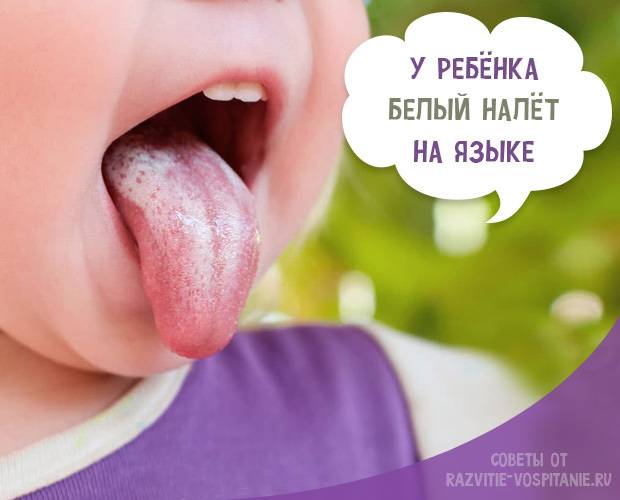 Причины образования белого налета на языке у грудничка и способы лечения