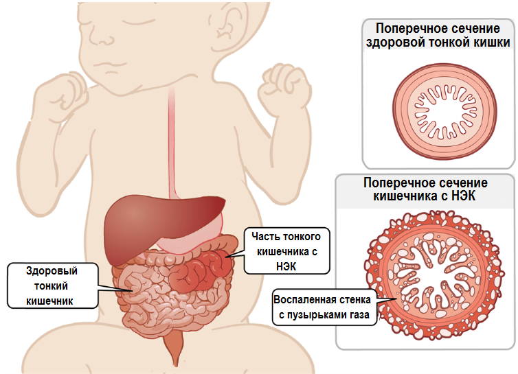 Симптомы колита кишечника у новорожденных и детей старшего возраста, лечение заболевания