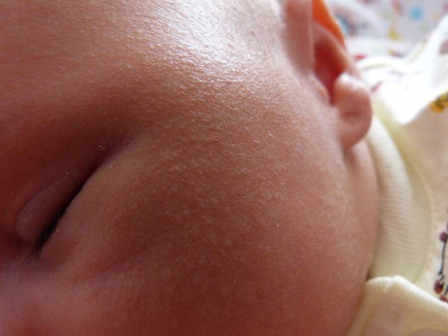 Чем и как лечить потницу у новорожденного ребенка?
