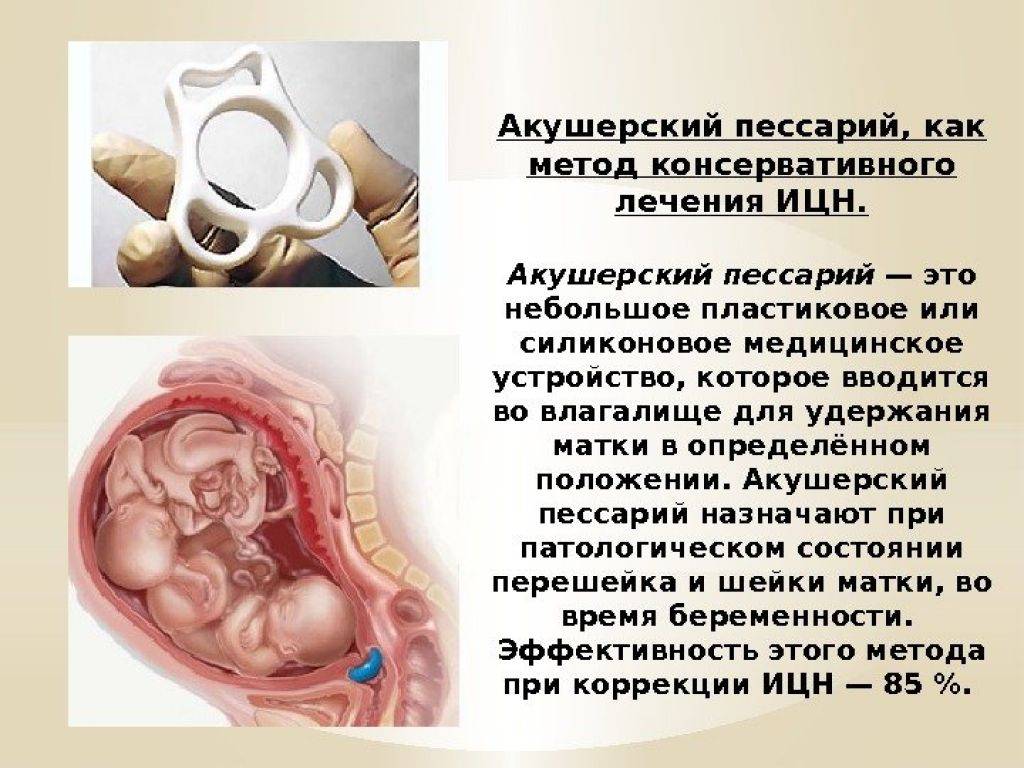 Акушерский пессарий при беременности: виды, причины установки, противопоказания