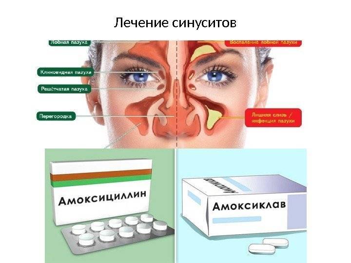 Фронтит схема лечения