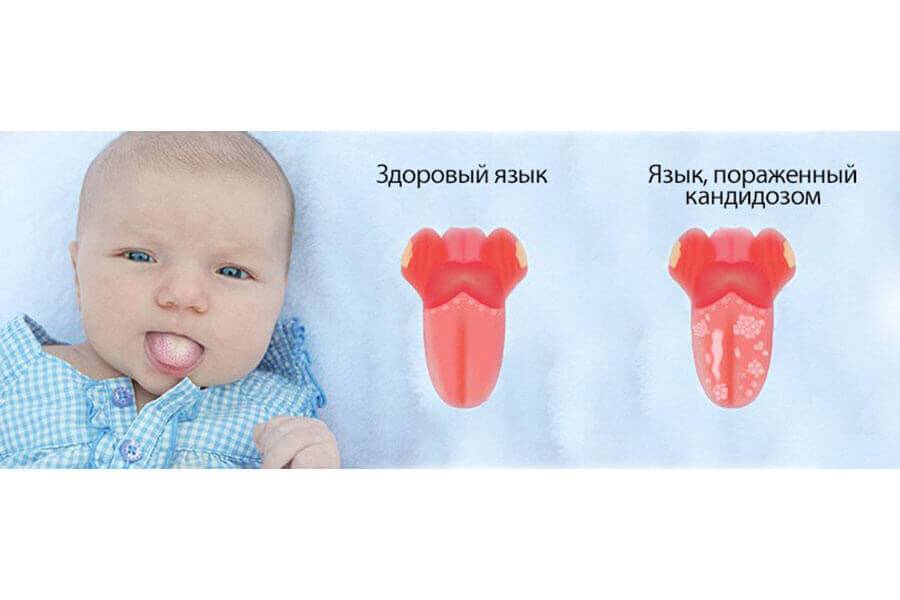 Кандидоз полости рта у детей: причины, симптомы, лечение
