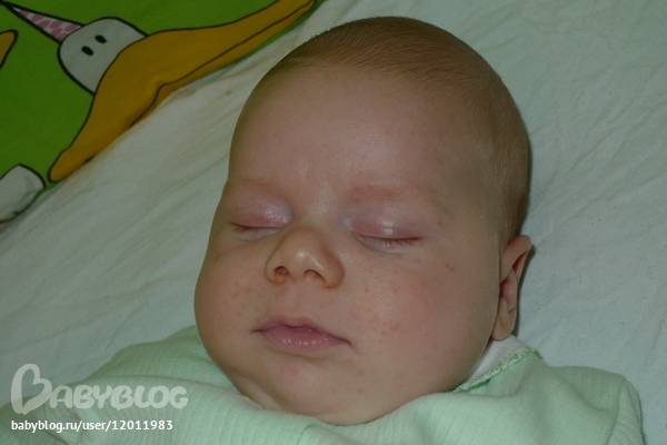 Цветение новорожденных: что делать и как лечить кожу у грудничка
