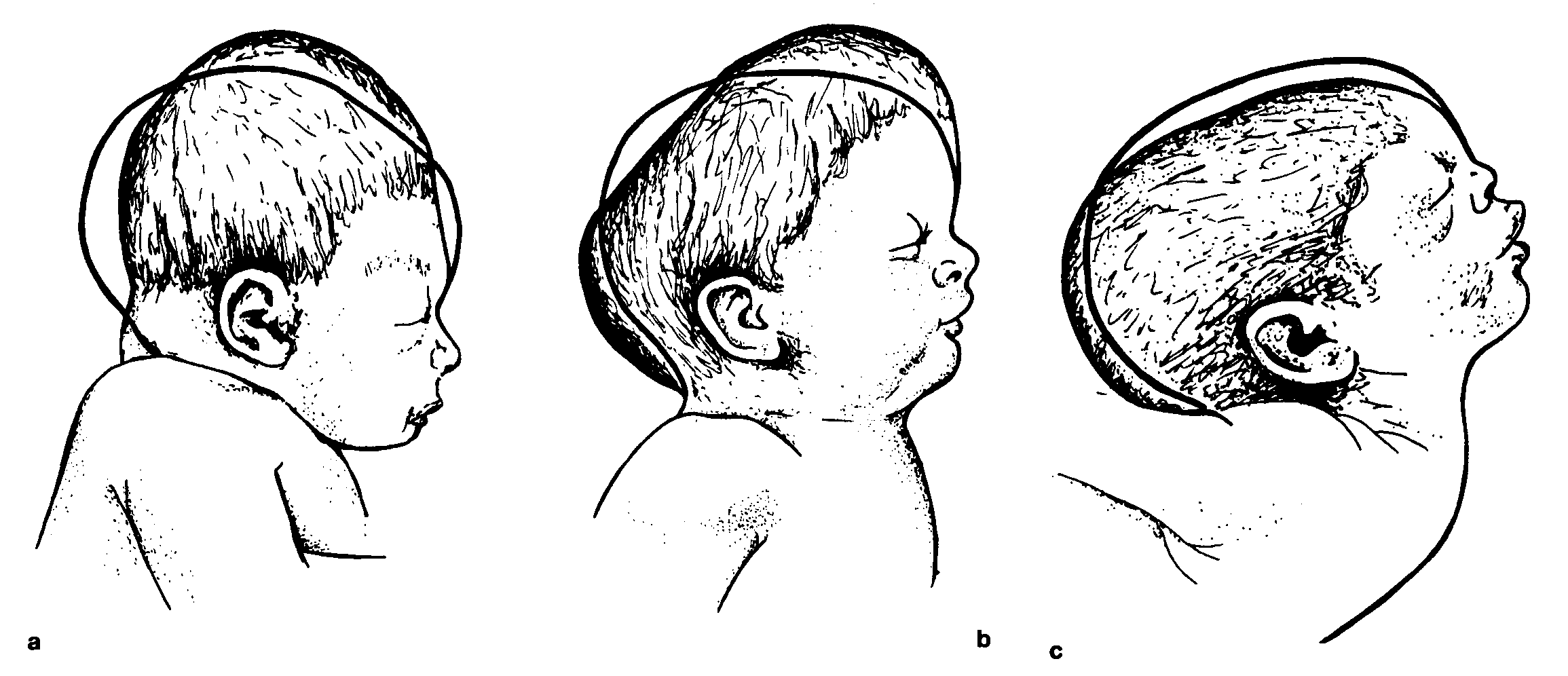 Плагиоцефалия у ребенка