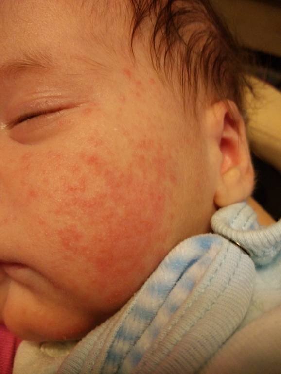 Цветение у новорожденных: как отличить от аллергии, это гормональное, как выглядит кожа, если цветет у грудничков