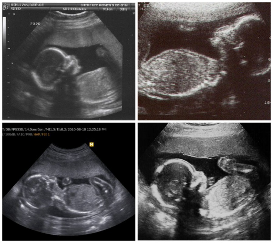 Почему на 21 недели. УЗИ ребенка на 21 неделе беременности. Фото УЗИ ребенка на 21 неделе беременности. УЗИ плода 21 неделя беременности. 21 Неделя беременности фото плода на УЗИ.