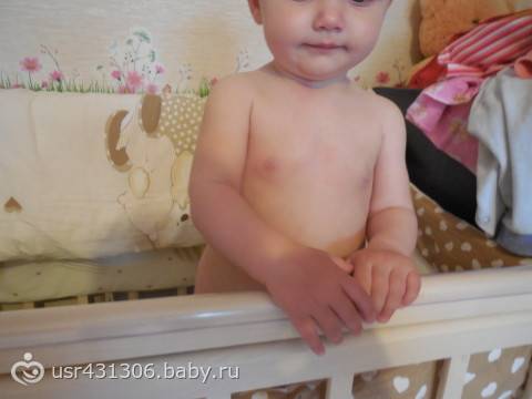 Изолированное телархе. Молочные железы у младенца 5 месяцев. Молочные железы у ребенка 1 год. Набухание молочных желез у ребенка.