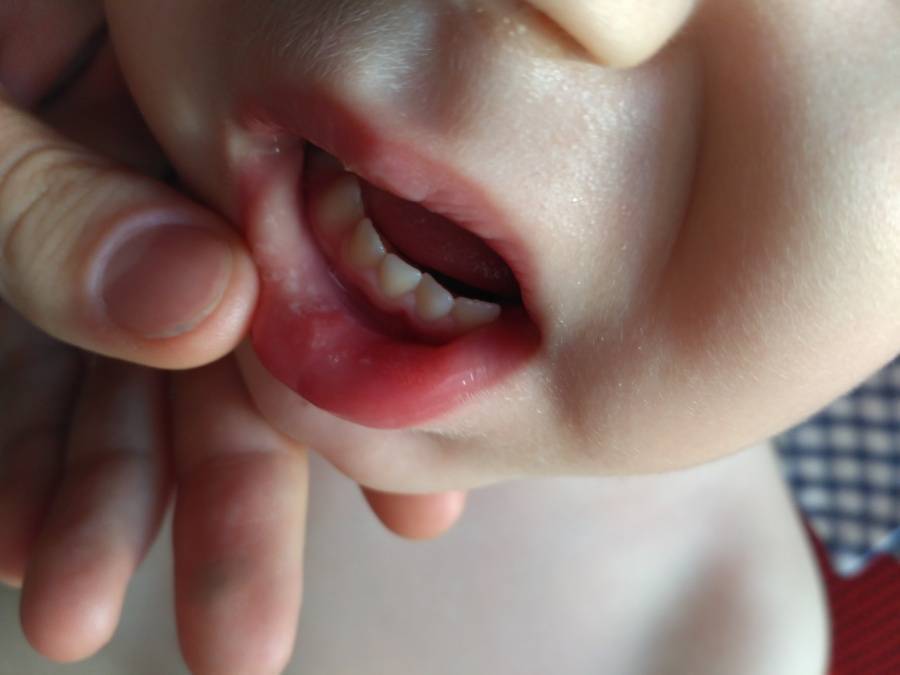 Кандидоз полости рта у детей: причины, лечение