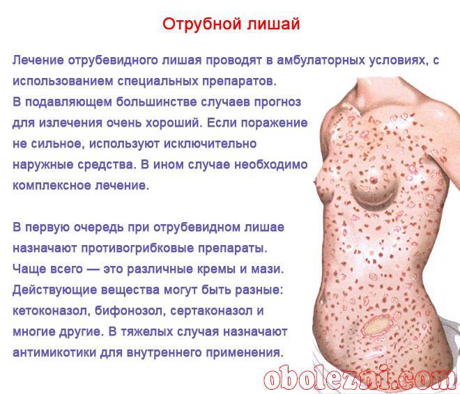 Лишай у ребенка