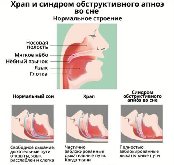 Как лечить заложенный нос у грудничка. закладывает нос у грудничка ночью
