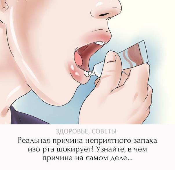 Галитоз: причины, виды и лечение неприятного запаха изо рта
