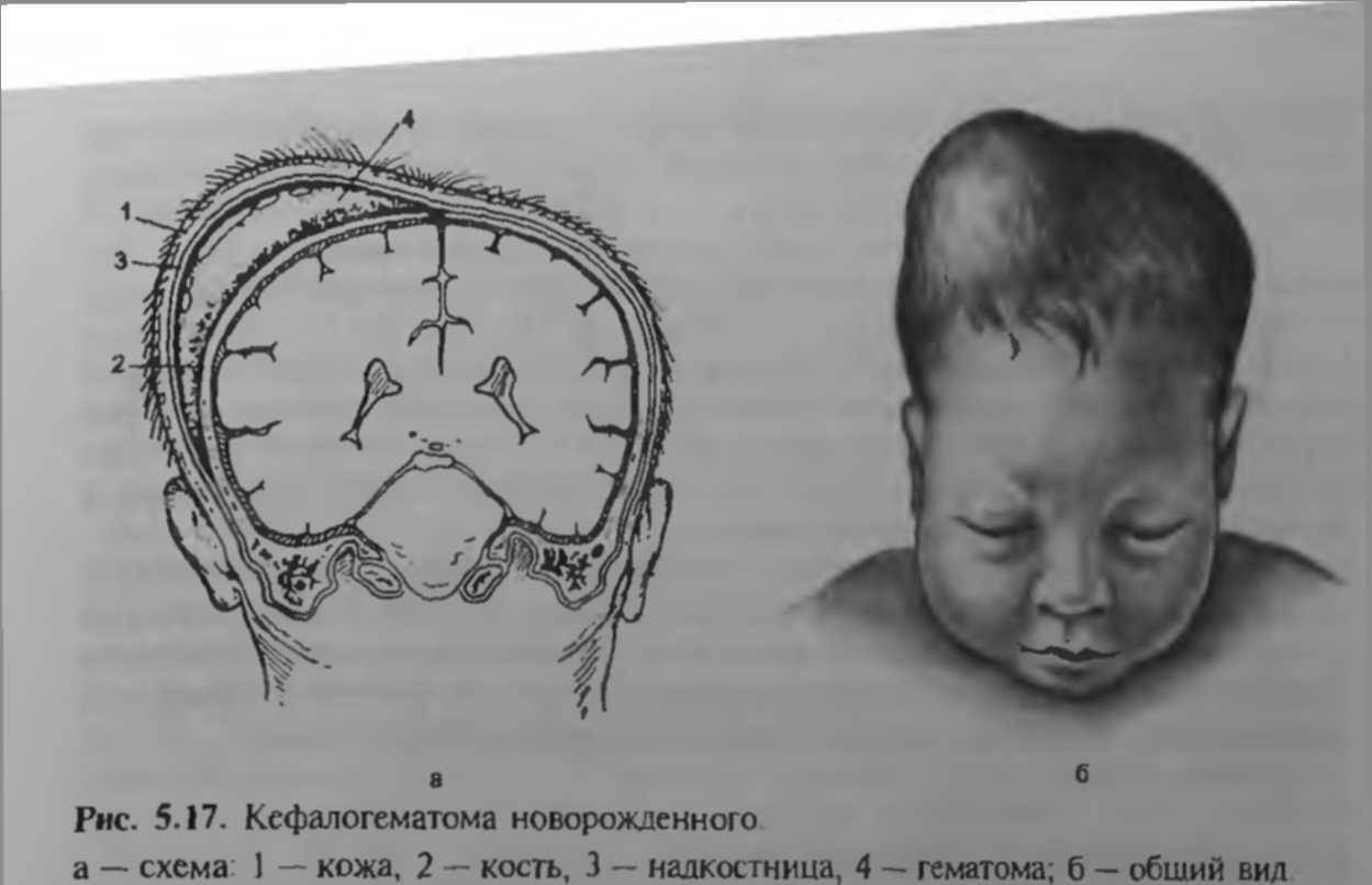 Кефалогематома у новорожденного на голове: последствия и лечение, причины и сроки рассасывания