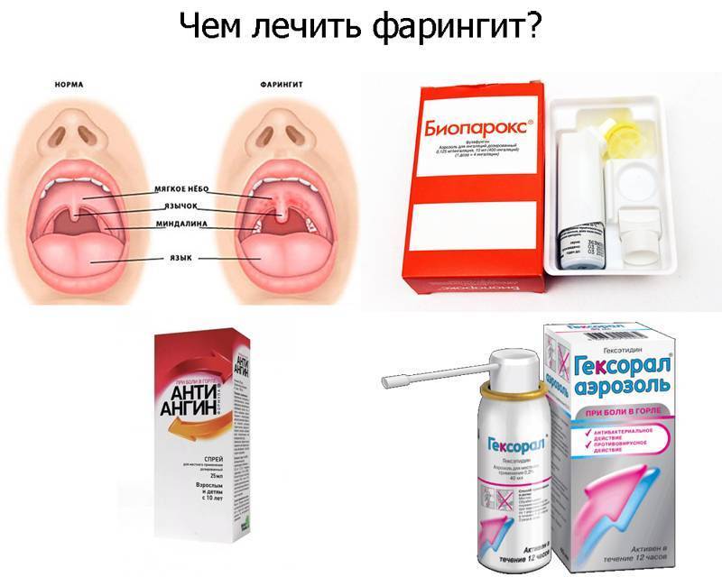 Фарингит – острый и хронический. симптомы и лечение фарингита.