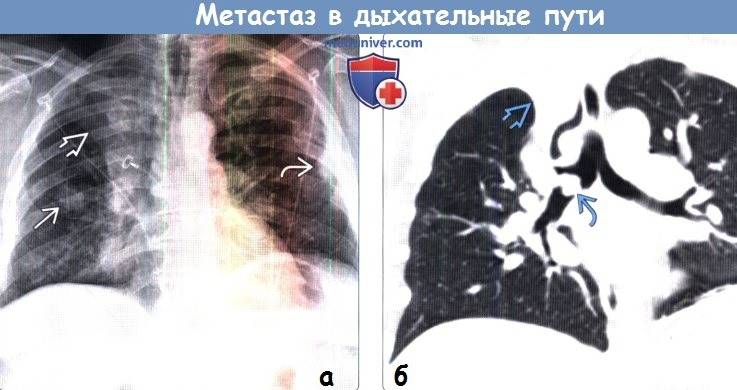 Рентген при грудном вскармливании и грудничкам: можно ли делать, последствия