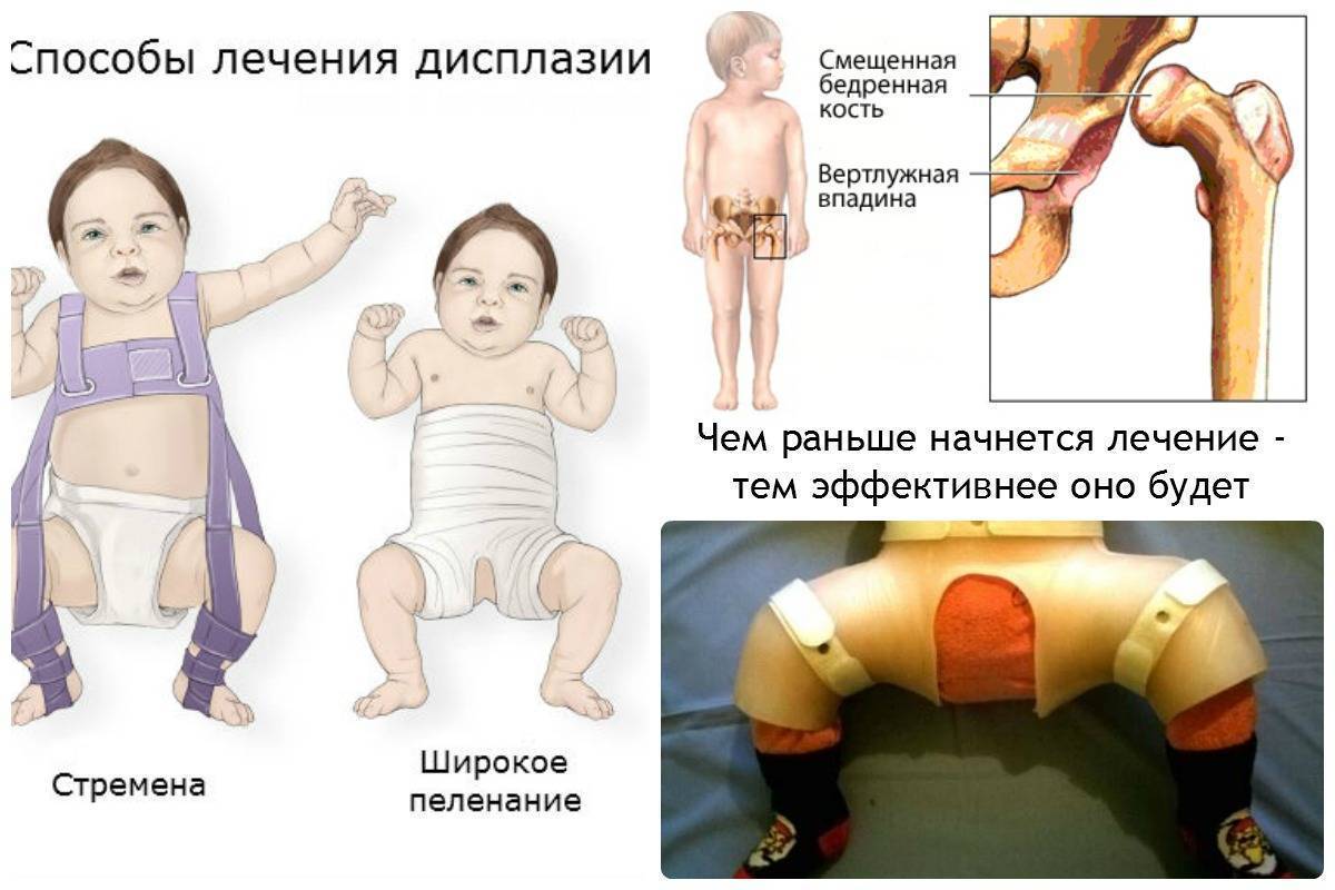 Узи тазобедренных суставов новорожденных: норма и патология