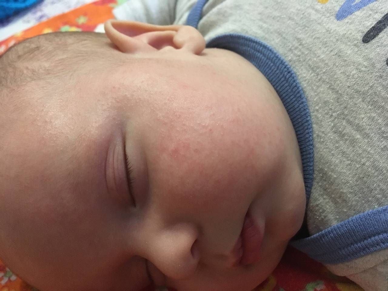 Потничка у новорожденных на лице: лечение и профилактика