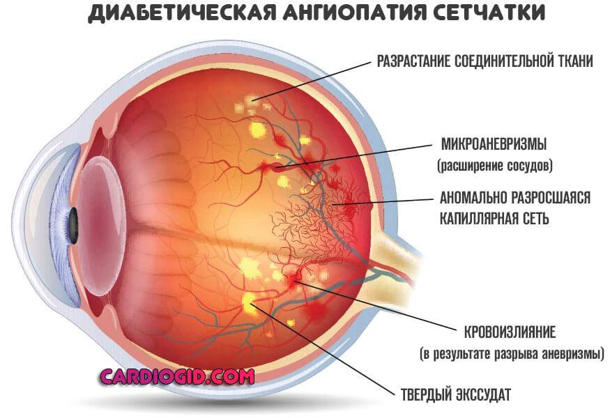 Ангиопатия и ретинопатия сетчатки. Почечная ретинопатия глазное дно. Отслоение сетчатки - ретинопатия.. Диабетическая микроангиопатия ретинопатия.