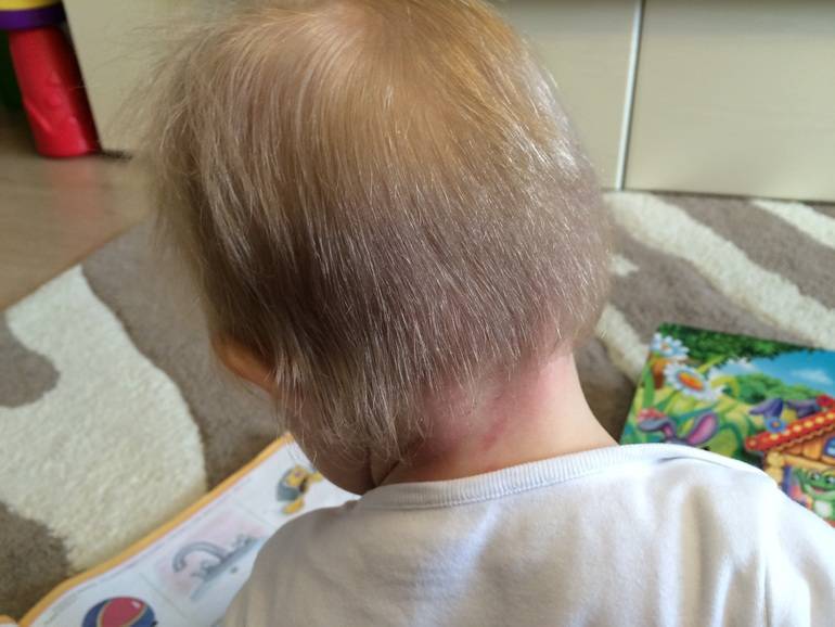 Что делать, если у малыша плохо растут волосы?