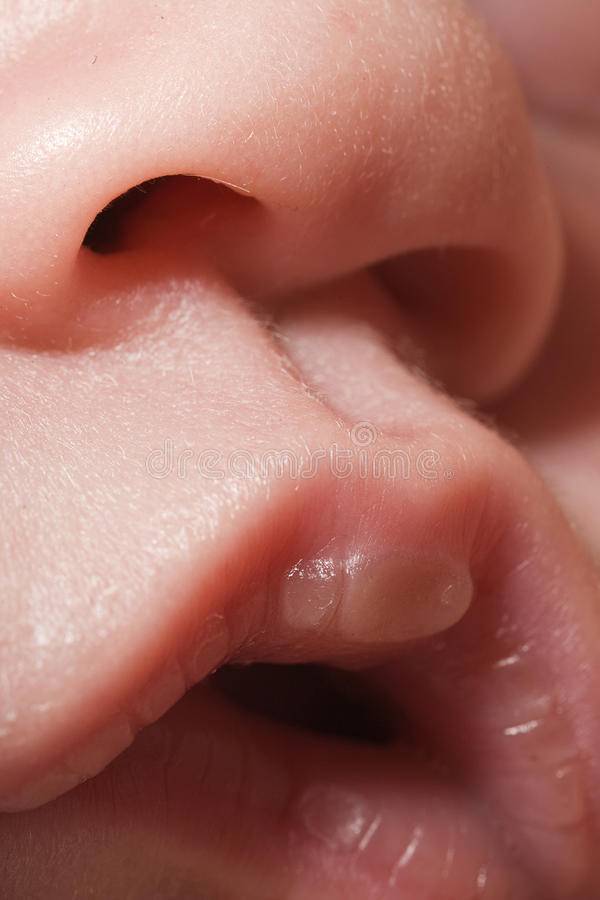 Мозоль на губе у новорожденного: причины, симптомы и лечение