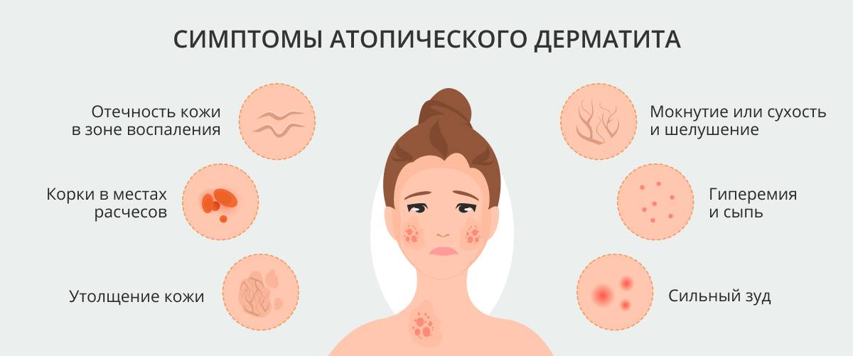 Чем снять зуд при аллергии у ребенка: убираем неприятные ощущения лекарствами и народными средствами