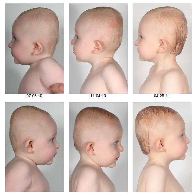 Затылок у ребенка в год. Форма головы новорожденного. Правильная форма головы. Формы черепа у новорожденных. Форма головы у грудничка.