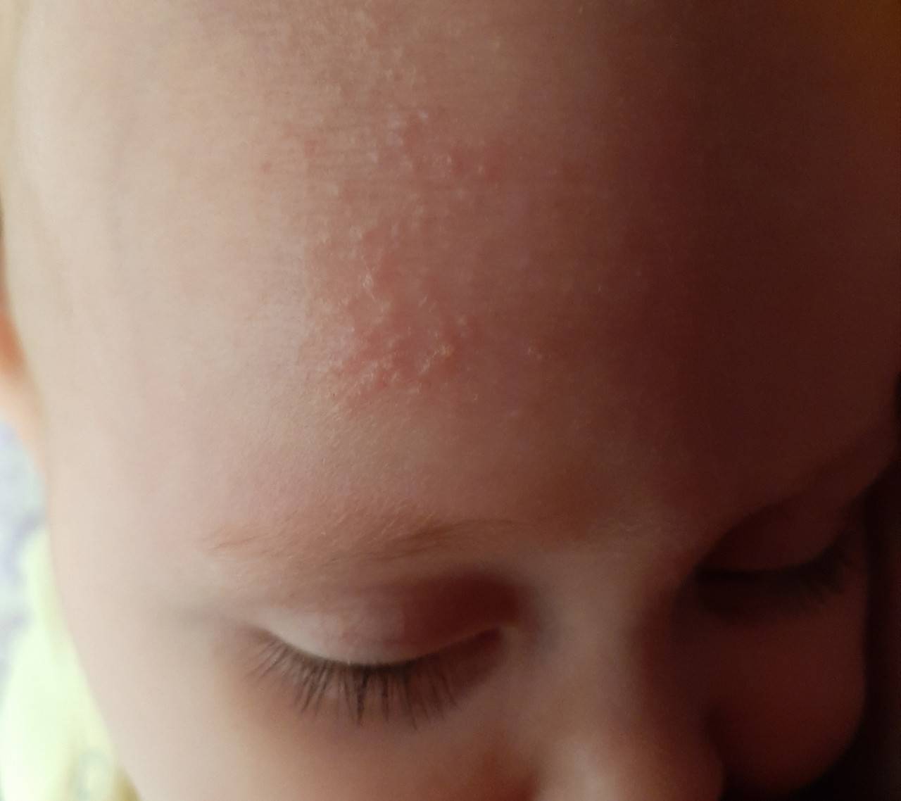 Сыпь на теле ребенка: особенности, виды, причины