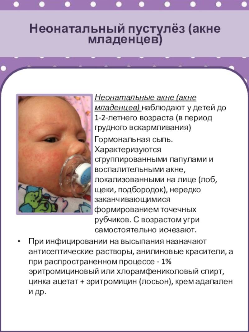 Прыщи у грудничков на лице: причины сыпи у новорожденных, лечение высыпаний у грудничков