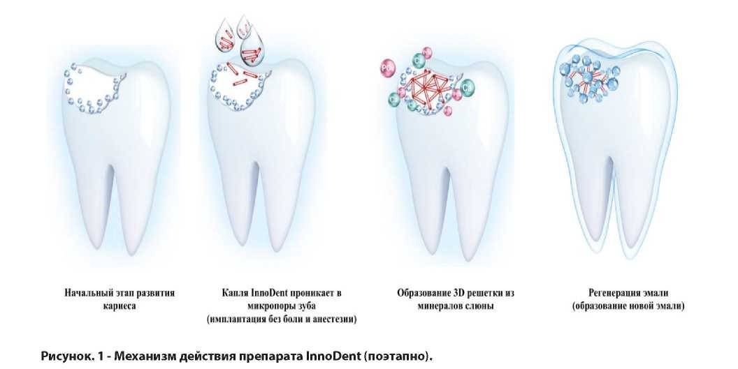 Кариес молочных зубов у детей раннего возраста (фото) и его причины