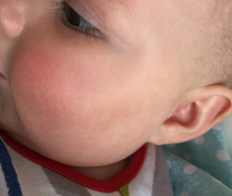 Аллергия на прикорм у ребенка фото