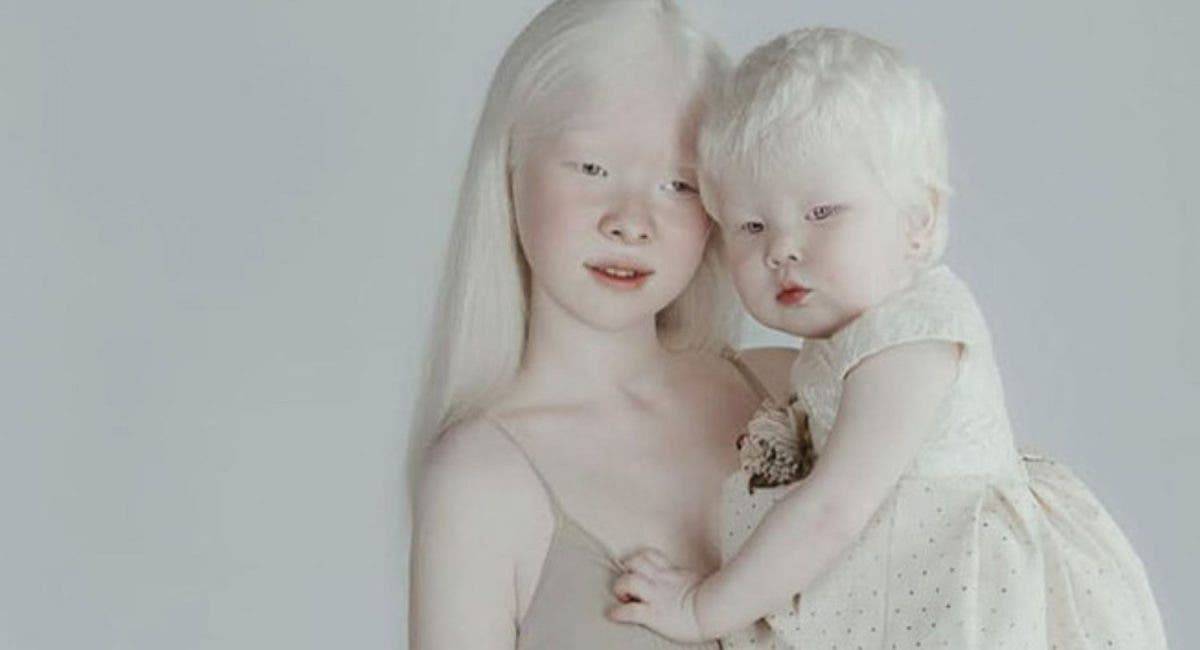 Альбинизм. причины, симптомы и лечение