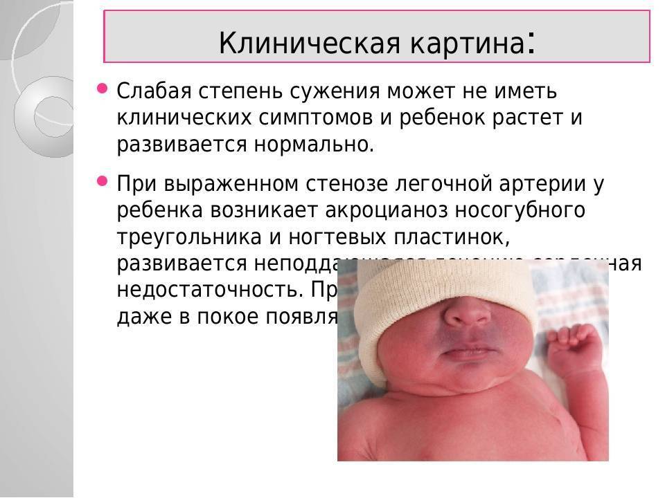 Врожденный порок сердца новорожденных — причины и последствия