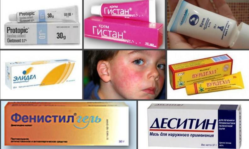Мазь и крем от аллергии (атопическом дерматите) на коже для детей: виды, обзор лучших препаратов