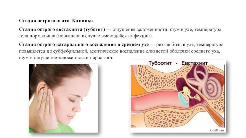 Средний и наружный отит -  симптомы и лечение, осложнения и профилактика воспаления уха.
