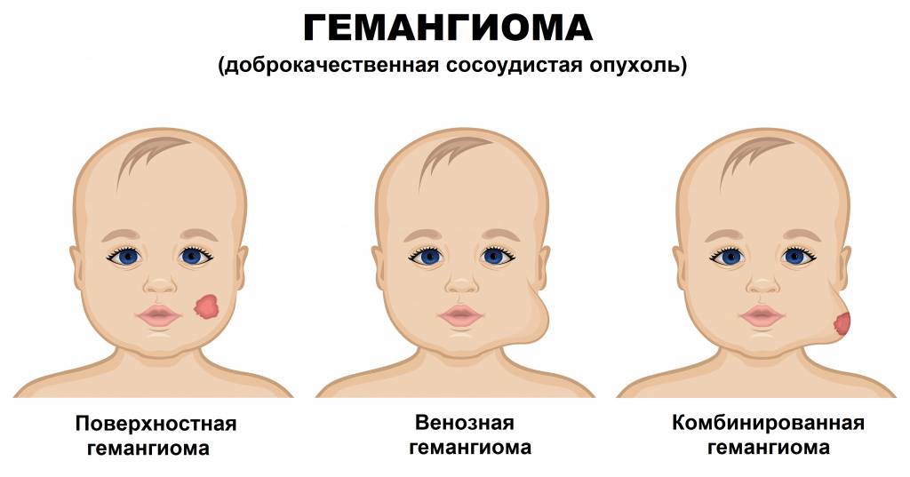 Виды гемангиом у новорожденных, причины возникновения и лечение