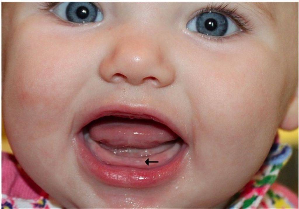 Прорезывание клыков у детей – симптомы, сроки и длительность, порядок появления