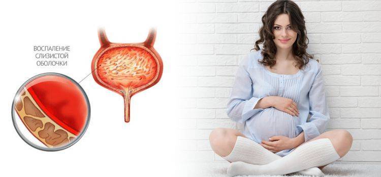 Цистит при беременности: профилактика и лечение