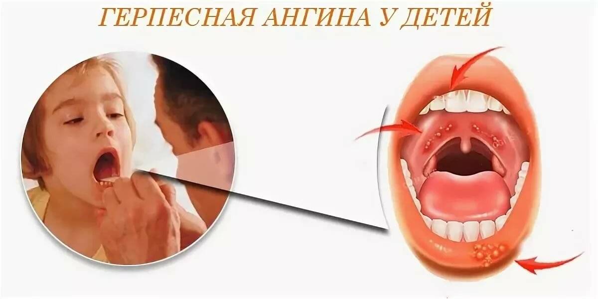 Как избавиться от герпесной ангины: эффективные методы лечения