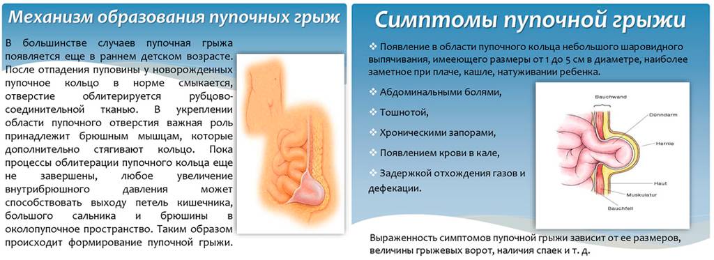 Пупочная грыжа у новорожденных (симптомы и лечение в домашних условиях)